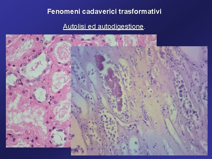 Fenomeni cadaverici trasformativi Autolisi ed autodigestione. 