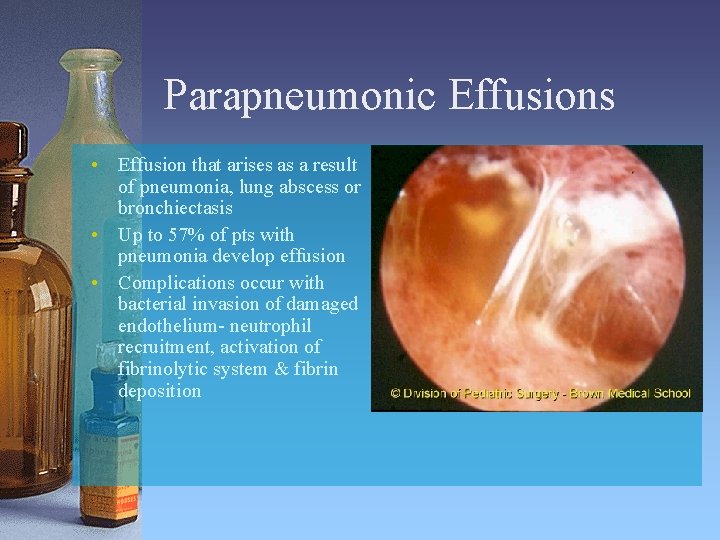 Parapneumonic Effusions • Effusion that arises as a result of pneumonia, lung abscess or