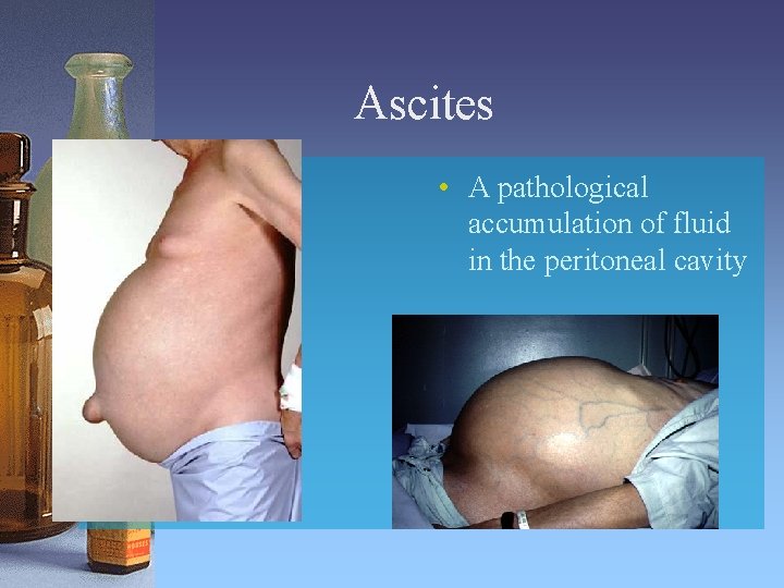 Ascites • A pathological accumulation of fluid in the peritoneal cavity 