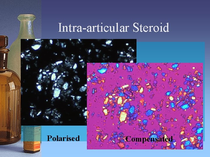 Intra-articular Steroid Polarised Compensated 