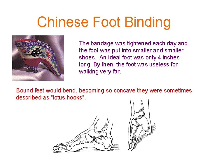 Chinese Foot Binding The bandage was tightened each day and the foot was put