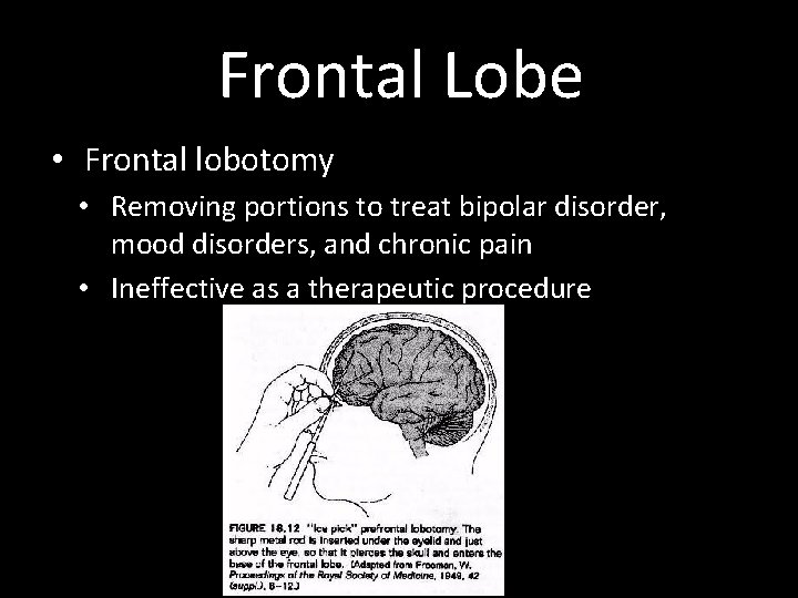 Frontal Lobe • Frontal lobotomy • Removing portions to treat bipolar disorder, mood disorders,