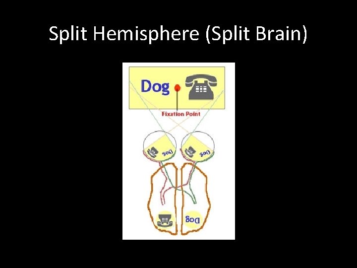 Split Hemisphere (Split Brain) 
