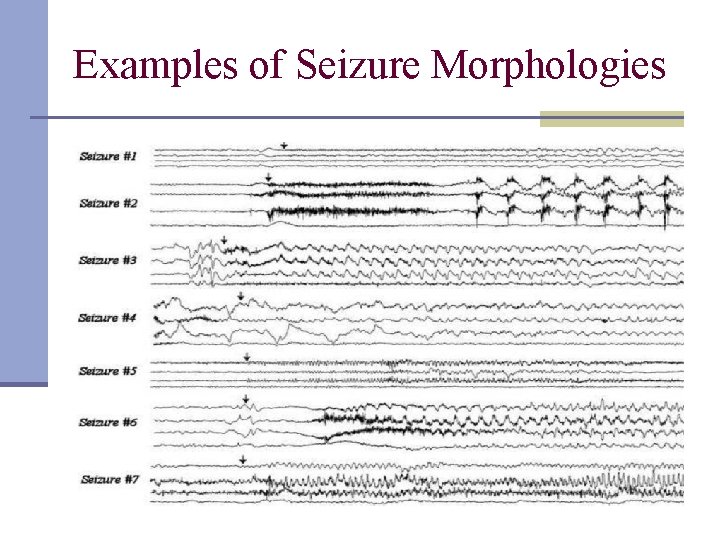 Examples of Seizure Morphologies 