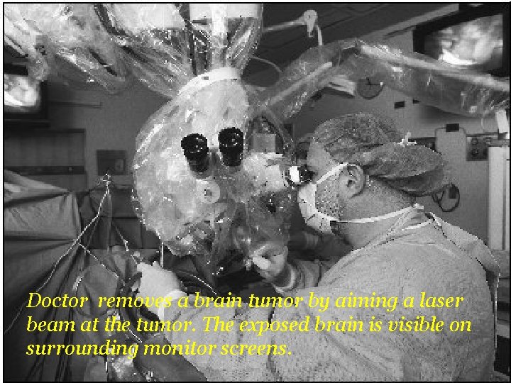 Doctor removes a brain tumor by aiming a laser beam at the tumor. The