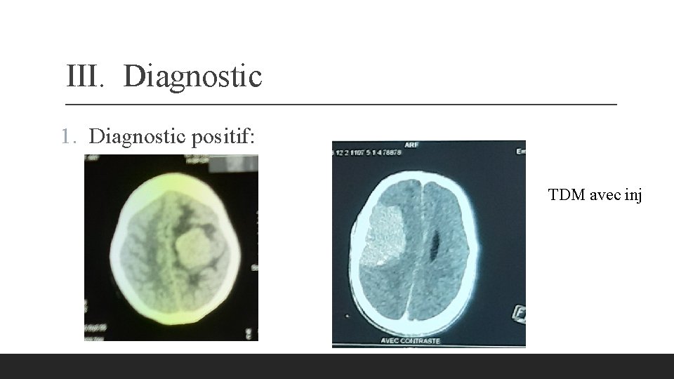 III. Diagnostic 1. Diagnostic positif: TDM avec inj 