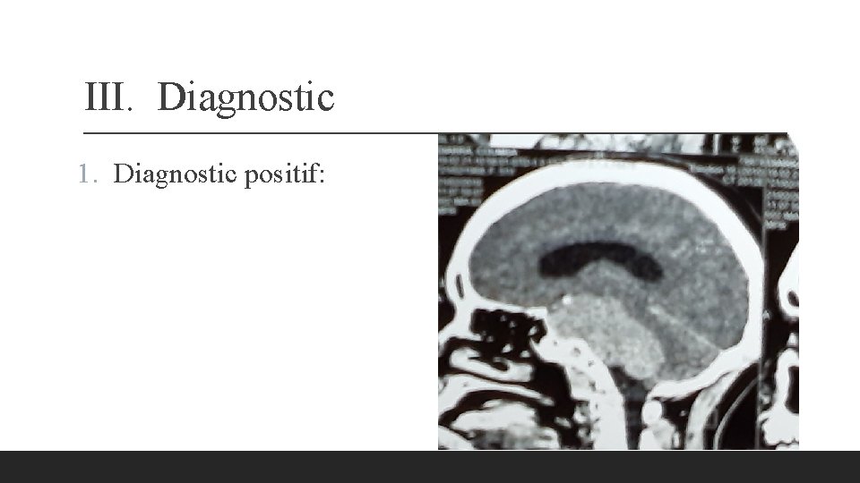 III. Diagnostic 1. Diagnostic positif: 