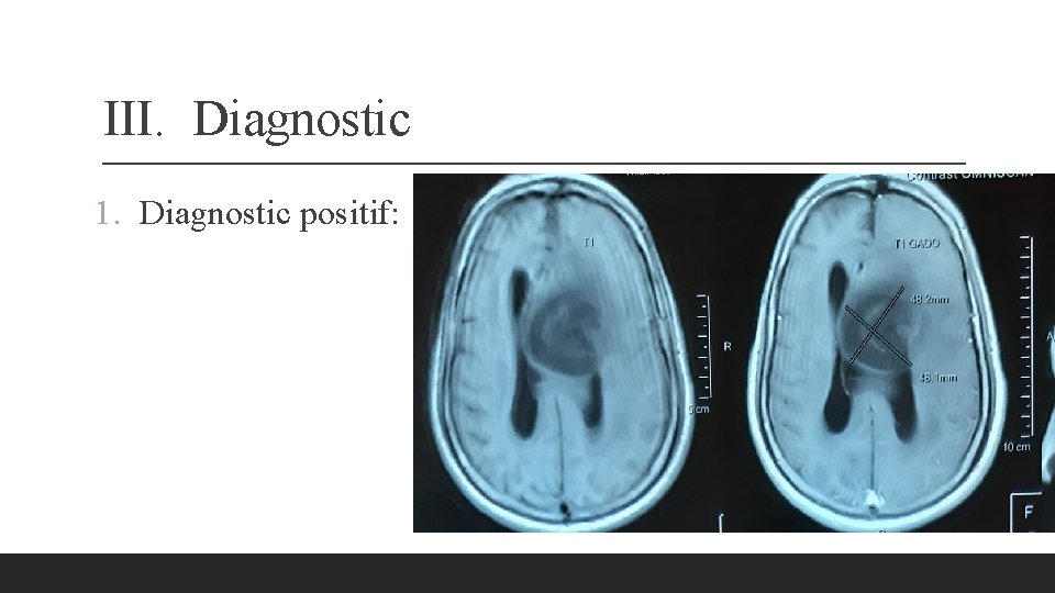 III. Diagnostic 1. Diagnostic positif: 