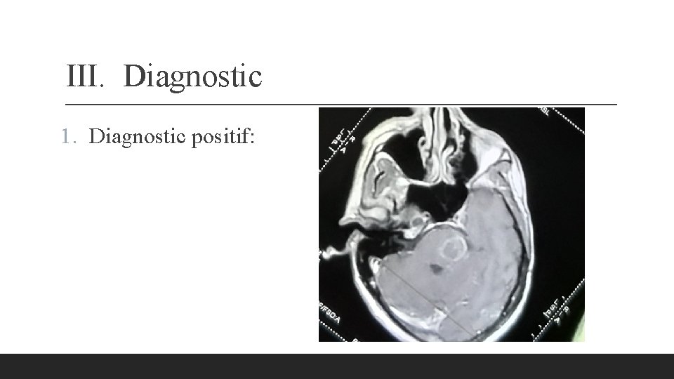 III. Diagnostic 1. Diagnostic positif: 