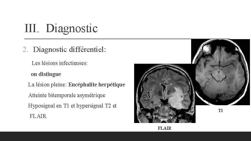 III. Diagnostic 2. Diagnostic différentiel: Les lésions infectieuses: on distingue La lésion pleine: Encéphalite