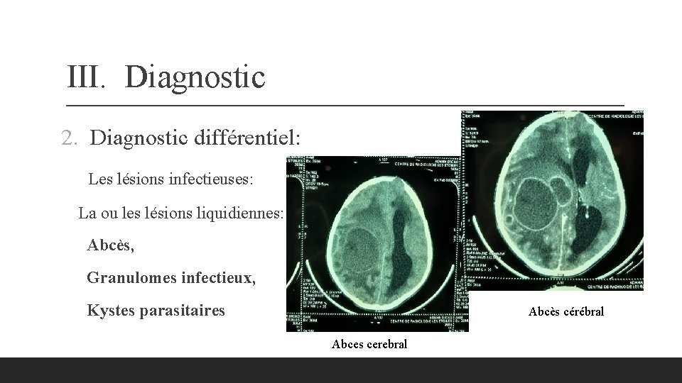 III. Diagnostic 2. Diagnostic différentiel: Les lésions infectieuses: La ou les lésions liquidiennes: Abcès,