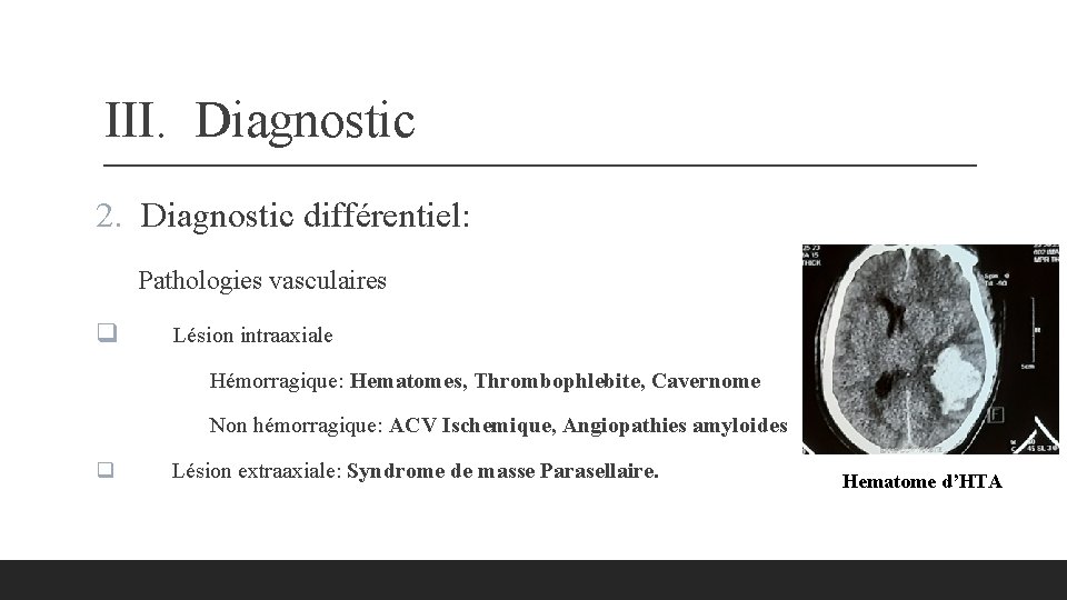 III. Diagnostic 2. Diagnostic différentiel: Pathologies vasculaires q Lésion intraaxiale Hémorragique: Hematomes, Thrombophlebite, Cavernome