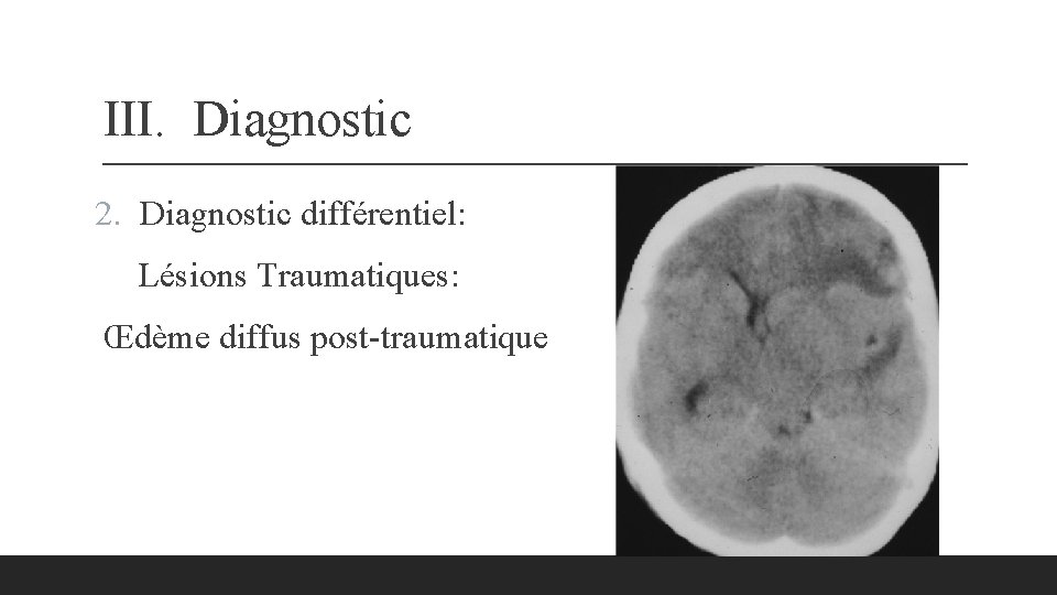 III. Diagnostic 2. Diagnostic différentiel: Lésions Traumatiques: Œdème diffus post-traumatique 
