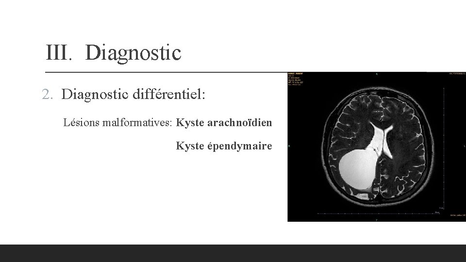 III. Diagnostic 2. Diagnostic différentiel: Lésions malformatives: Kyste arachnoïdien Kyste épendymaire 