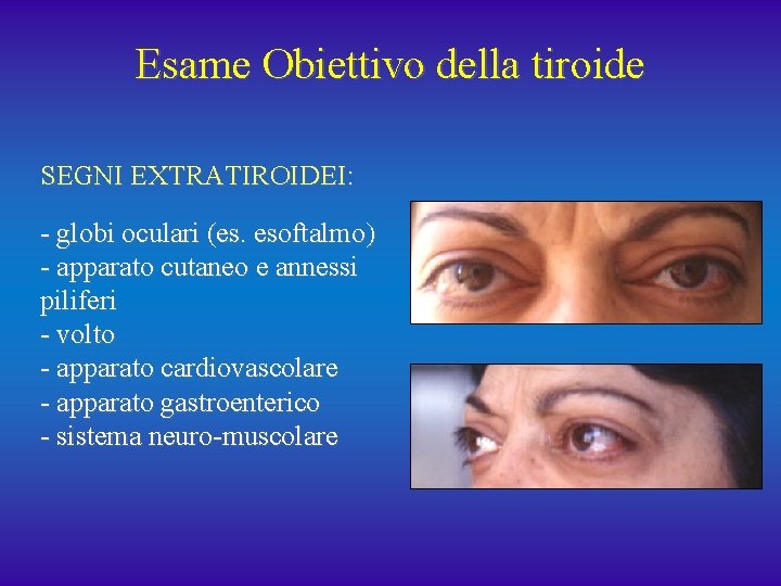 Esame Obiettivo della tiroide SEGNI EXTRATIROIDEI: - globi oculari (es. esoftalmo) - apparato cutaneo