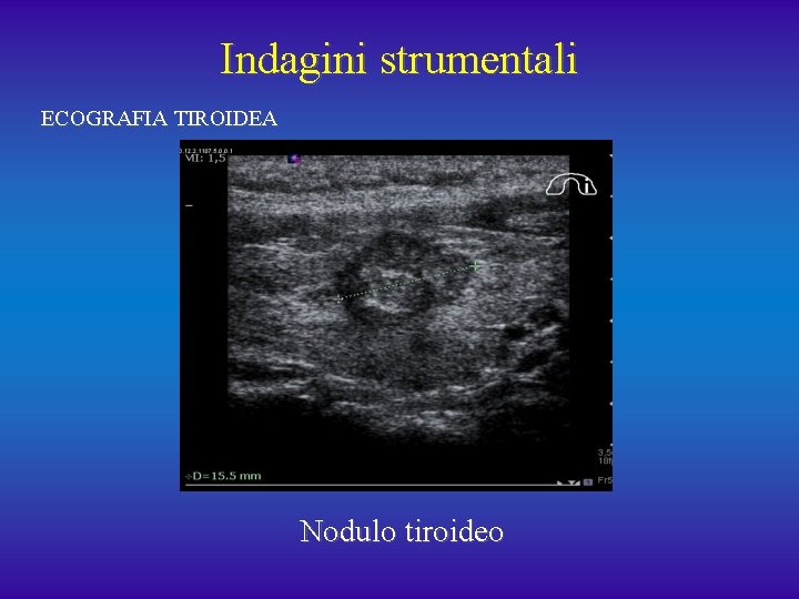 Indagini strumentali ECOGRAFIA TIROIDEA Nodulo tiroideo 