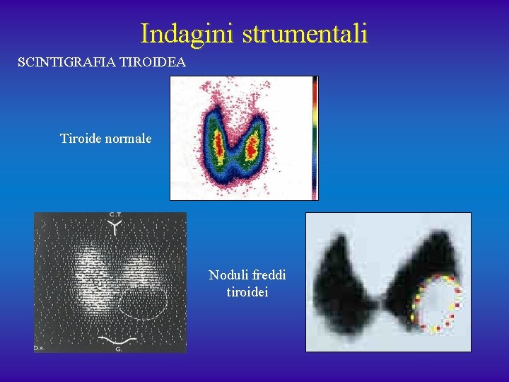 Indagini strumentali SCINTIGRAFIA TIROIDEA Tiroide normale Noduli freddi tiroidei 