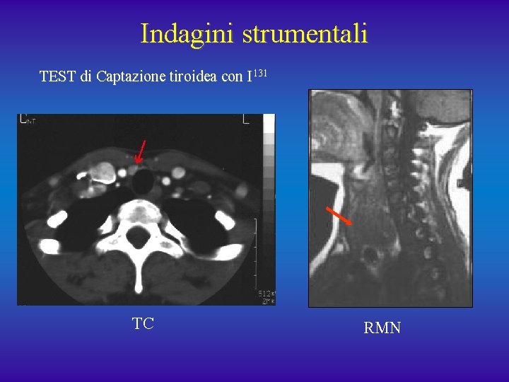 Indagini strumentali TEST di Captazione tiroidea con I 131 TC RMN 