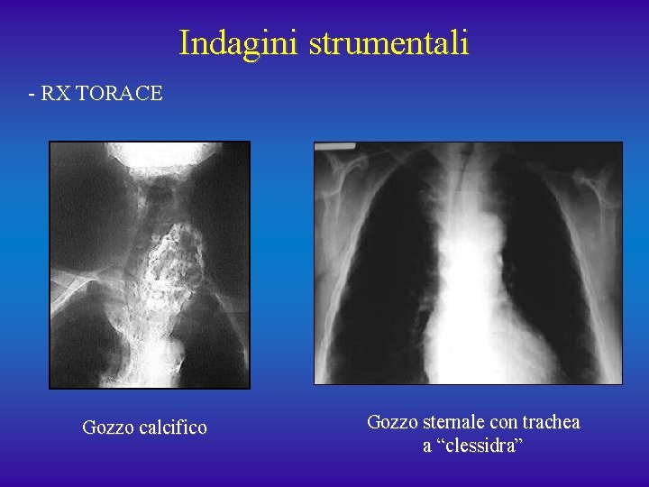 Indagini strumentali - RX TORACE Gozzo calcifico Gozzo sternale con trachea a “clessidra” 
