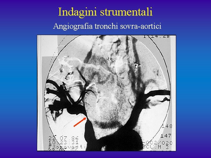 Indagini strumentali Angiografia tronchi sovra-aortici 