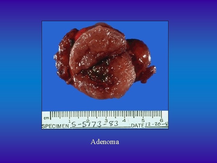 Adenoma 