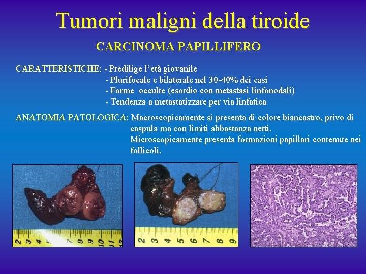 Tumori maligni della tiroide CARCINOMA PAPILLIFERO CARATTERISTICHE: - Predilige l’età giovanile - Plurifocale e