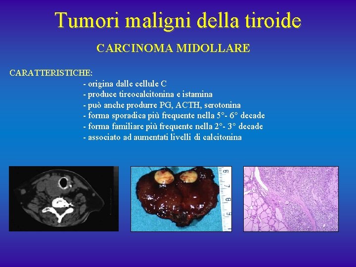 Tumori maligni della tiroide CARCINOMA MIDOLLARE CARATTERISTICHE: - origina dalle cellule C - produce