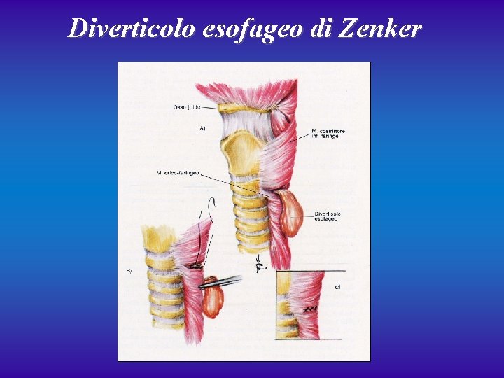 Diverticolo esofageo di Zenker 