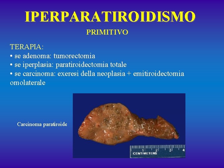 IPERPARATIROIDISMO PRIMITIVO TERAPIA: • se adenoma: tumorectomia • se iperplasia: paratiroidectomia totale • se