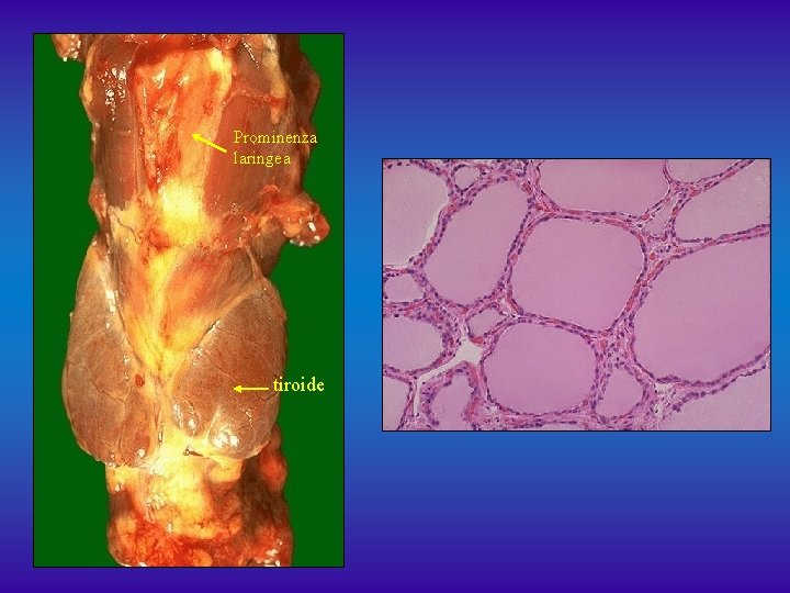 Prominenza laringea tiroide 