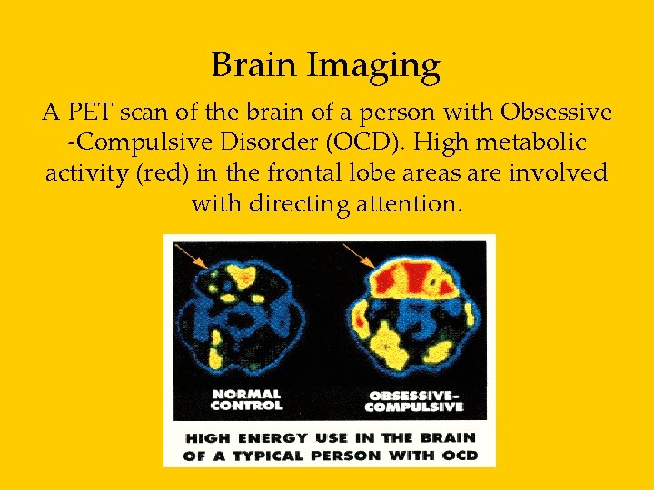 Brain Imaging A PET scan of the brain of a person with Obsessive -Compulsive