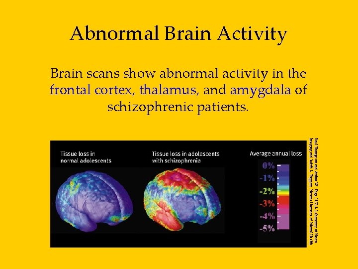 Abnormal Brain Activity Brain scans show abnormal activity in the frontal cortex, thalamus, and