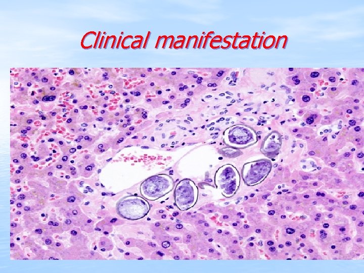 Clinical manifestation 