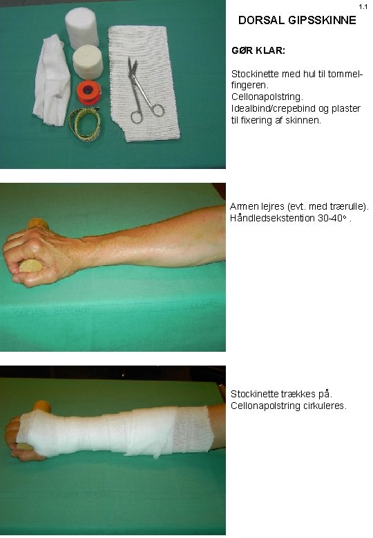 1. 1 DORSAL GIPSSKINNE GØR KLAR: Stockinette med hul til tommelfingeren. Cellonapolstring. Idealbind/crepebind og