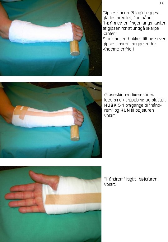 1. 2 Gipseskinnen (8 lag) lægges – glattes med let, flad hånd. ”Kør” med