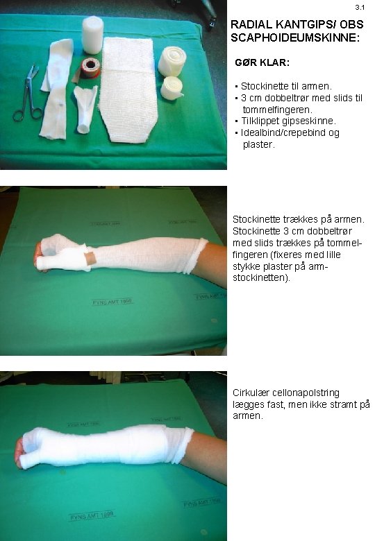 3. 1 RADIAL KANTGIPS/ OBS SCAPHOIDEUMSKINNE: GØR KLAR: • Stockinette til armen. • 3