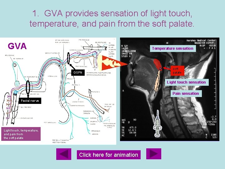 1. GVA provides sensation of light touch, temperature, and pain from the soft palate.