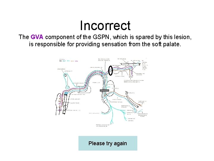 Incorrect The GVA component of the GSPN, which is spared by this lesion, is