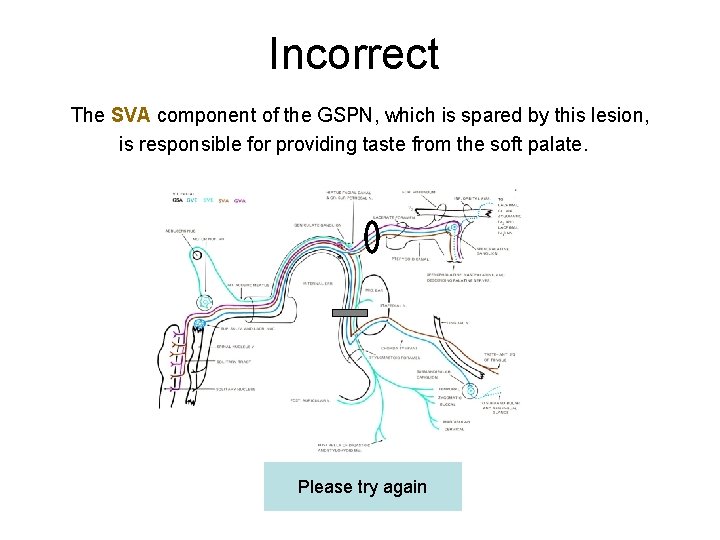 Incorrect The SVA component of the GSPN, which is spared by this lesion, is