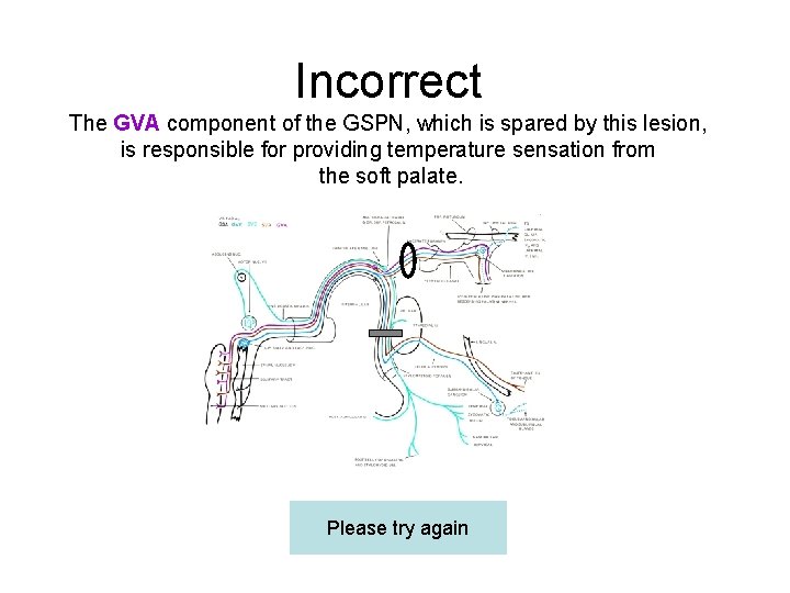 Incorrect The GVA component of the GSPN, which is spared by this lesion, is