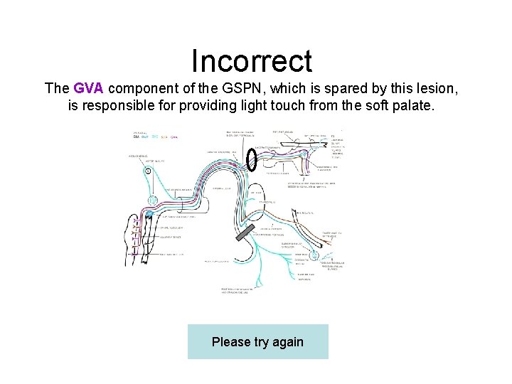 Incorrect The GVA component of the GSPN, which is spared by this lesion, is