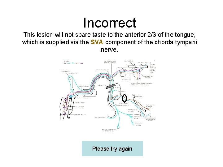 Incorrect This lesion will not spare taste to the anterior 2/3 of the tongue,