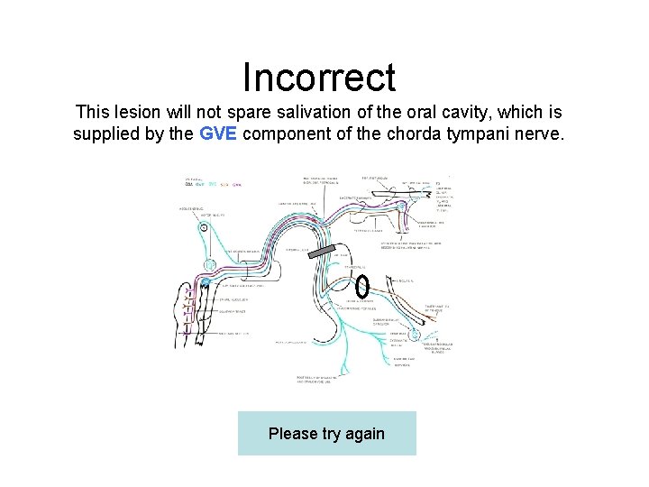 Incorrect This lesion will not spare salivation of the oral cavity, which is supplied