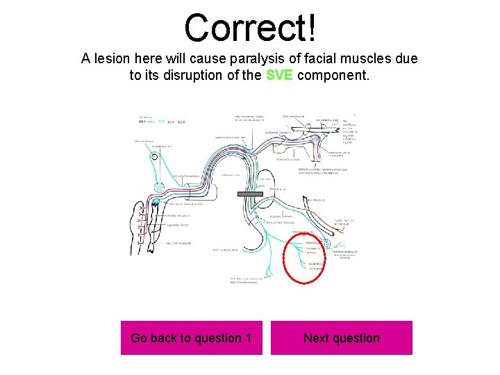 Correct! A lesion here will cause paralysis of facial muscles due to its disruption