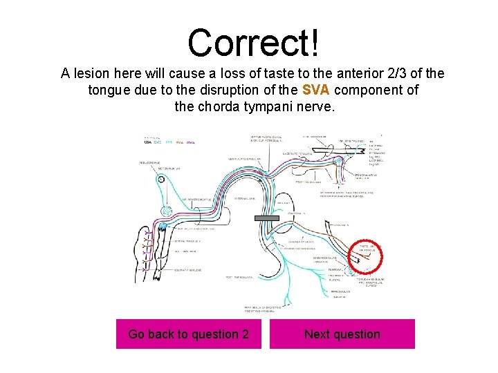 Correct! A lesion here will cause a loss of taste to the anterior 2/3