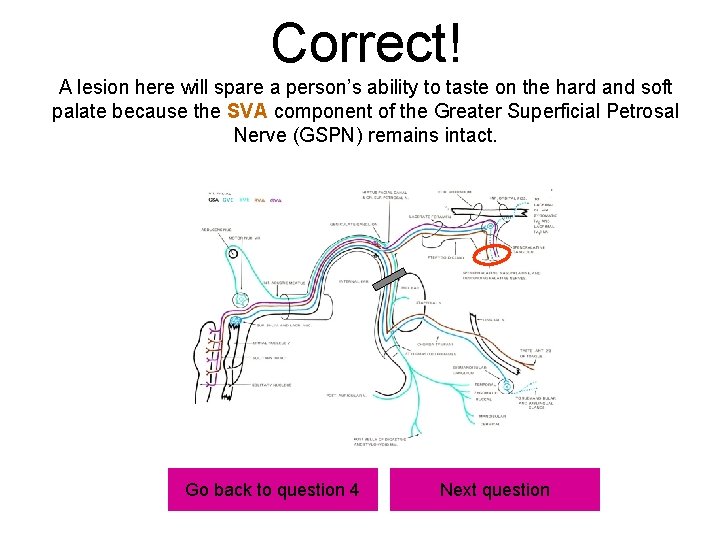 Correct! A lesion here will spare a person’s ability to taste on the hard