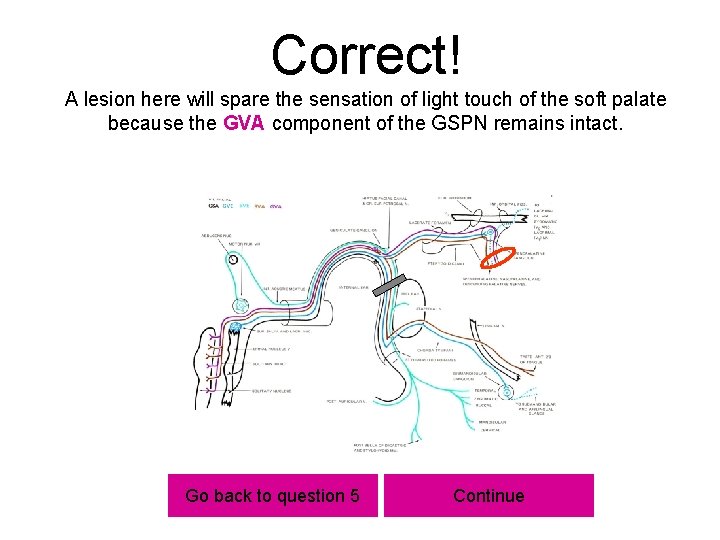 Correct! A lesion here will spare the sensation of light touch of the soft