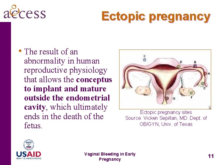 Ectopic pregnancy • The result of an abnormality in human reproductive physiology that allows