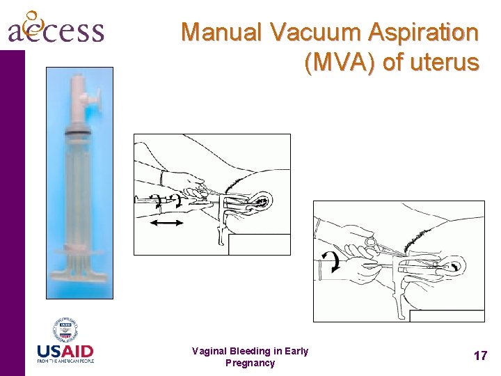 Manual Vacuum Aspiration (MVA) of uterus Vaginal Bleeding in Early Pregnancy 17 