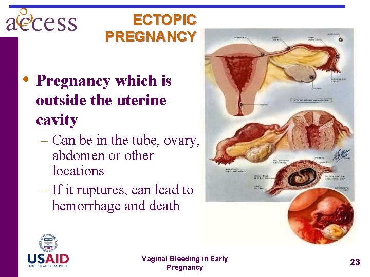 ECTOPIC PREGNANCY • Pregnancy which is outside the uterine cavity – Can be in